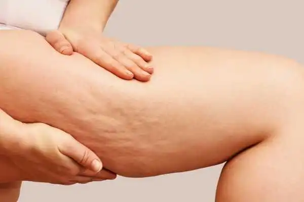 Image of woman showing leg with cellulite Brentford