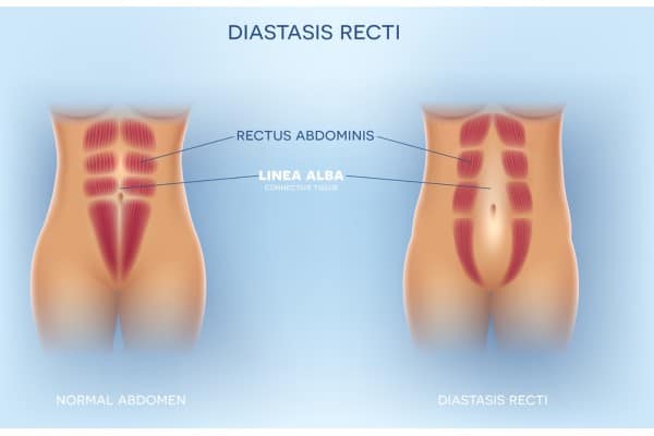 What Non-Surgical Options Are Available for Diastasis Recti Brentford?