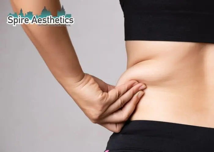 Image of woman pinching fat on their hips Brentford. Fat Freezing treatment