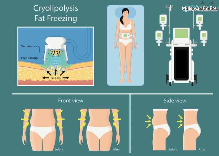 Image of diet and fat freezing combined for best results for Spire Aesthetics Brentford