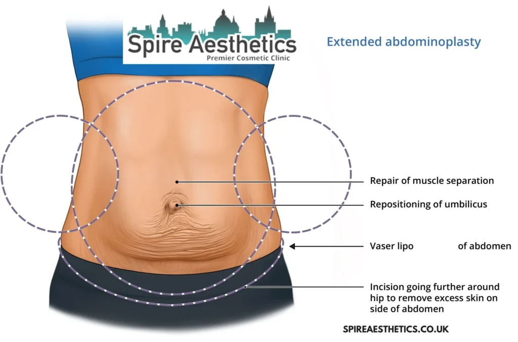 Understanding Loose Skin After Gastric Band Brentford Surgery and HIFU Treatment