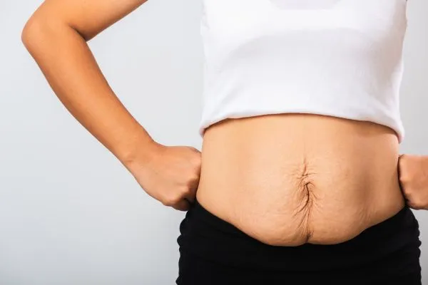 Image of a woman's stomach after weight loss with sagging skin following a gastric band Brentford