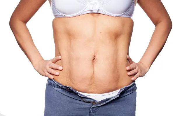 sagging skin on woman's stomach after weight loss injections Brentford