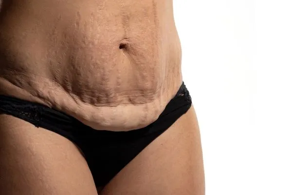 Image of womans stomach after weight loss injections Brentford showing saggy skin