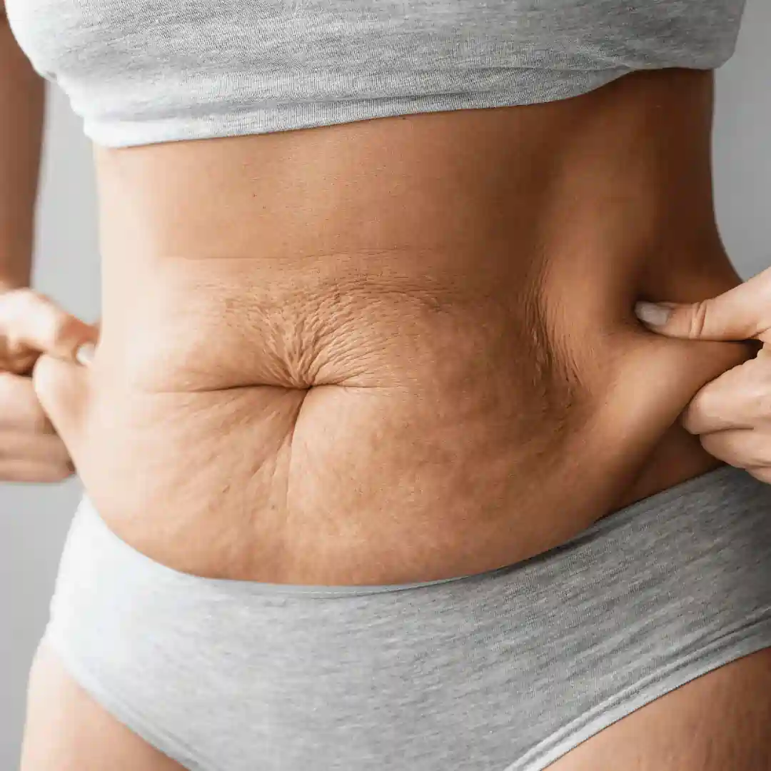 Is It Normal to Have Loose Skin After Pregnancy Brentford?