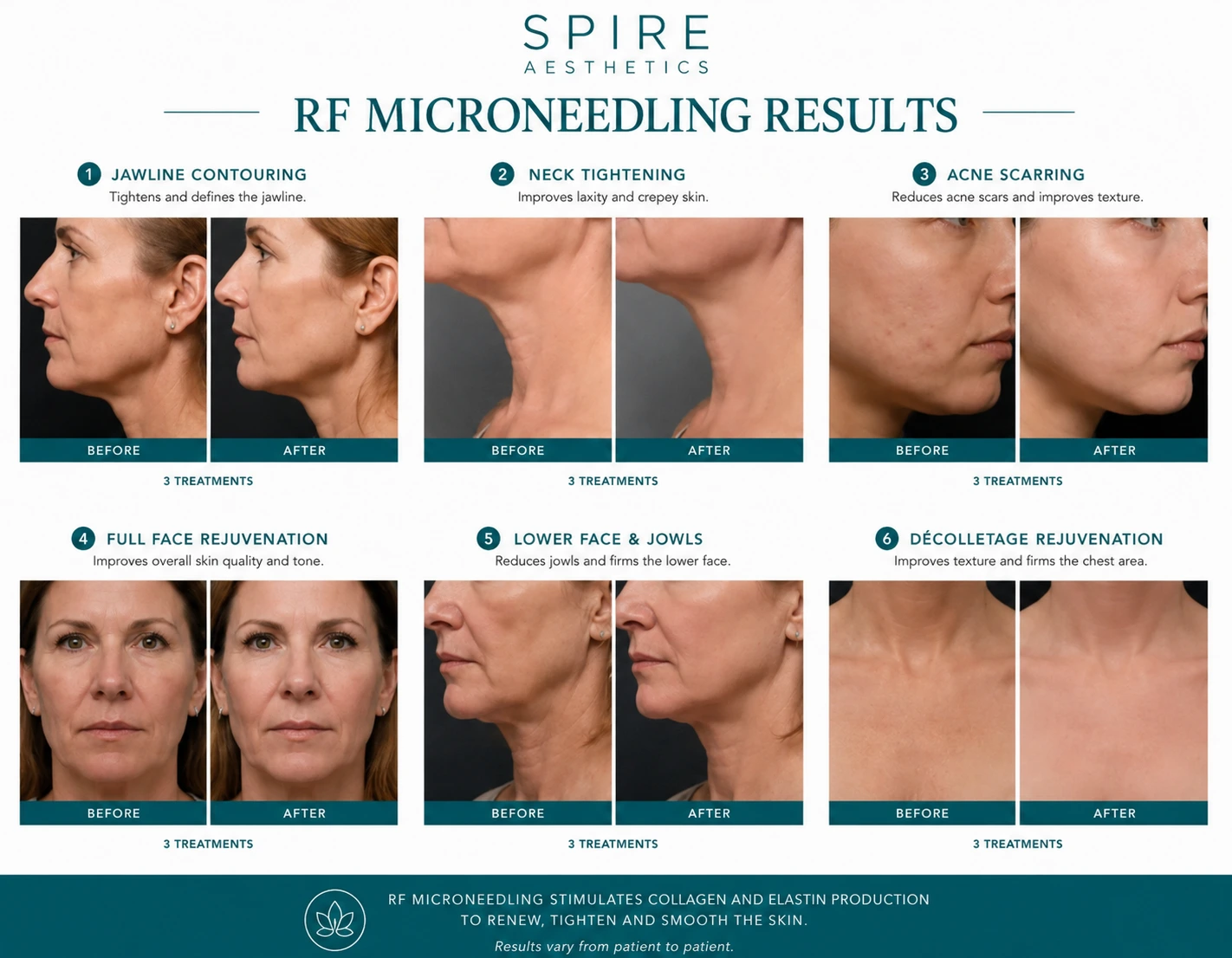 RF Microneedling Skin tightening Brentford results