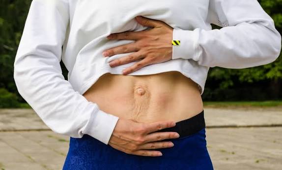 When Could Diastasis Recti Be the Missing Piece of the Puzzle Brentford?
