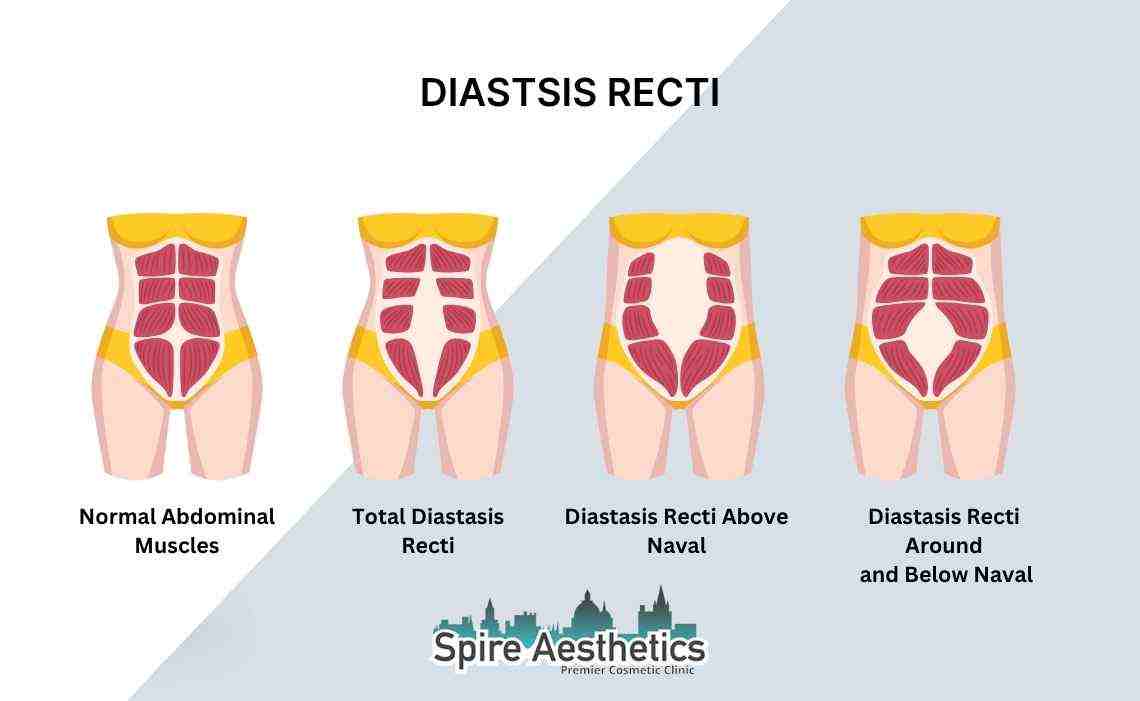 Is Non-Surgical Diastasis Recti Treatment Right for You? Common Concerns Answered Brentford